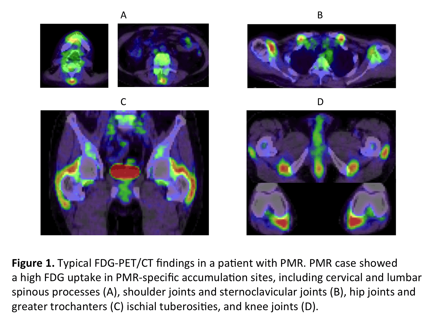 �à–¾: Macintosh HD:Users:hideyukihorikoshi:Documents:Desktop Groups:Rheumatology study:PMR PET:PMR ACR 2014:ACR PMR figure:figure 1.gif