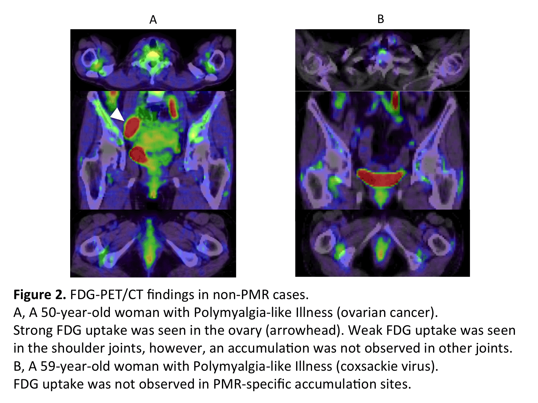 �à–¾: Macintosh HD:Users:hideyukihorikoshi:Documents:Desktop Groups:Rheumatology study:PMR PET:PMR ACR 2014:ACR PMR figure:figure 2.gif