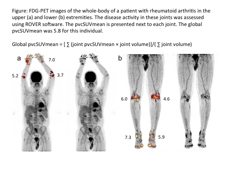 Evaluating Rheumatoid Arthritis Disease Activity Using Global