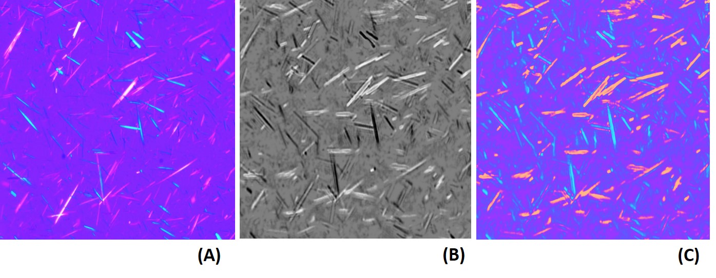 gout vs pseudogout crystals