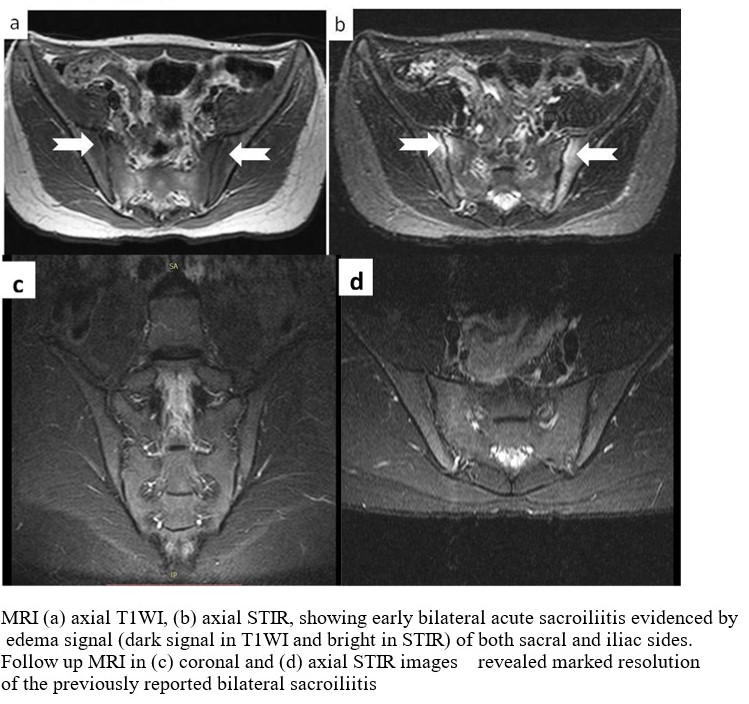 Сакроилеит на мрт фото