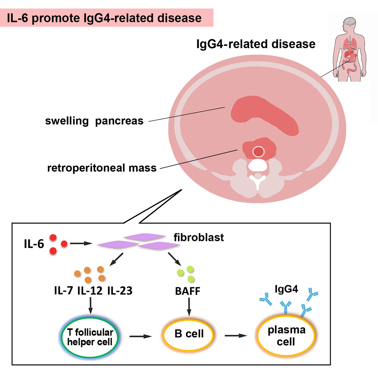 Igg4 Related Disease