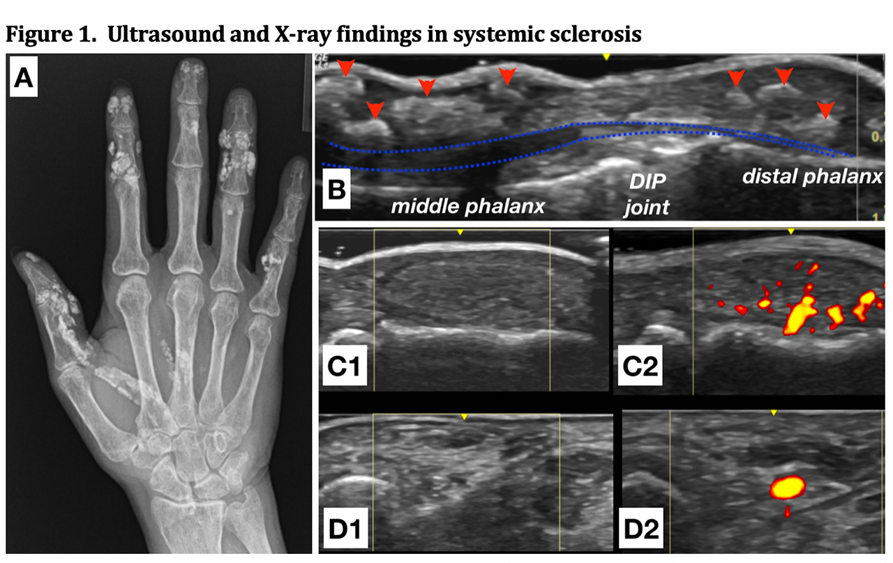 calcinosis scleroderma