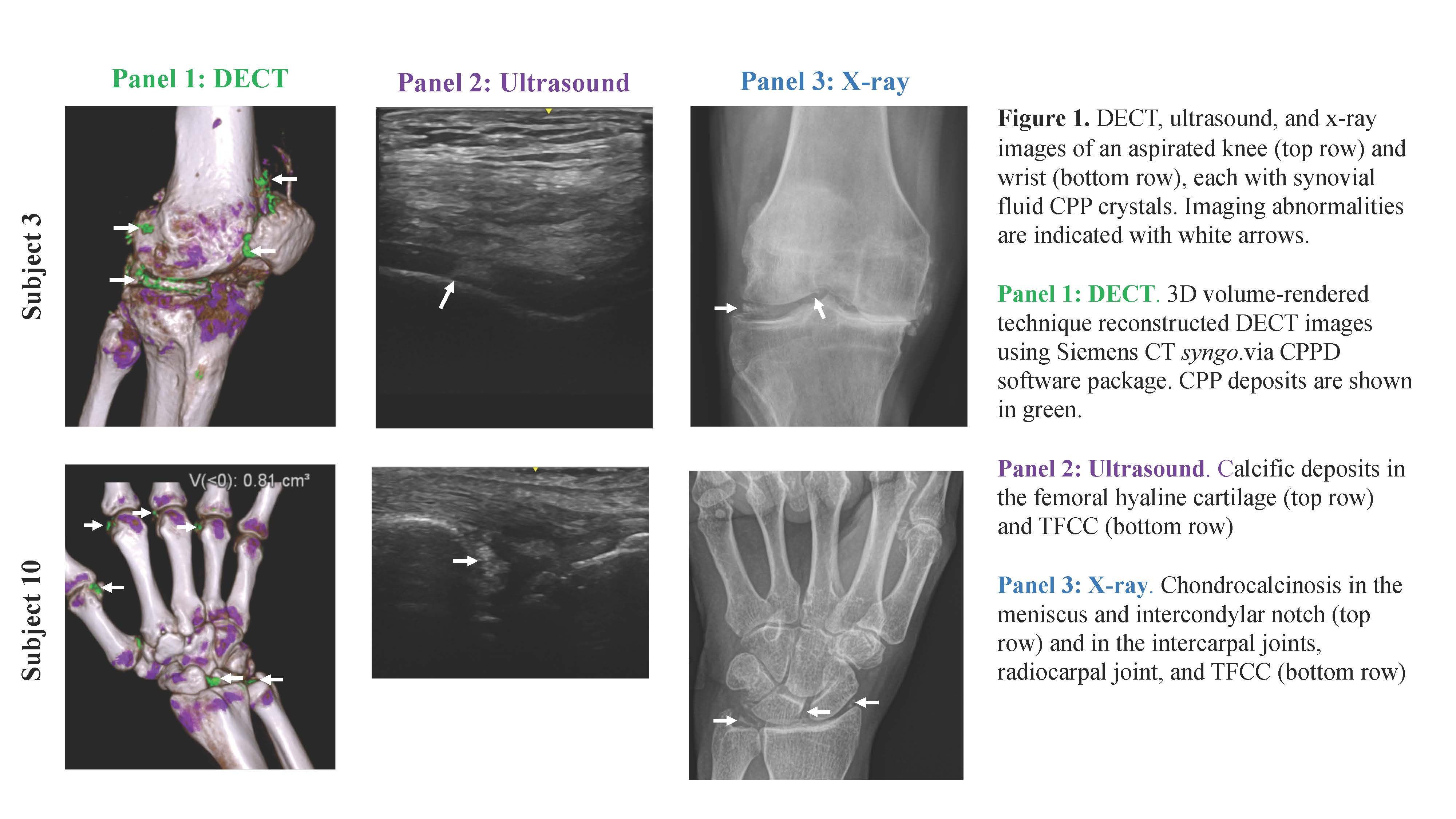 Gout Vs Pseudogout Crystals