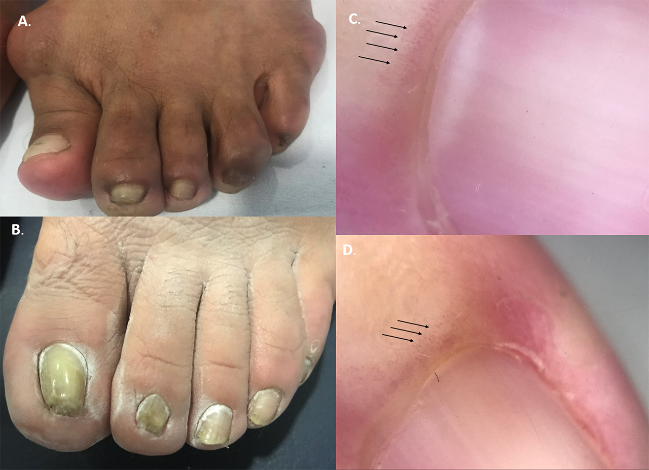 Raynaud's phenomenon and positive antinuclear antibodies as first  manifestation of POEMS syndrome (polyneuropathy, organomegaly,  endocrinopathy, monoclonal gammopathy, and skin changes): a case report |  BMC Rheumatology | Full Text