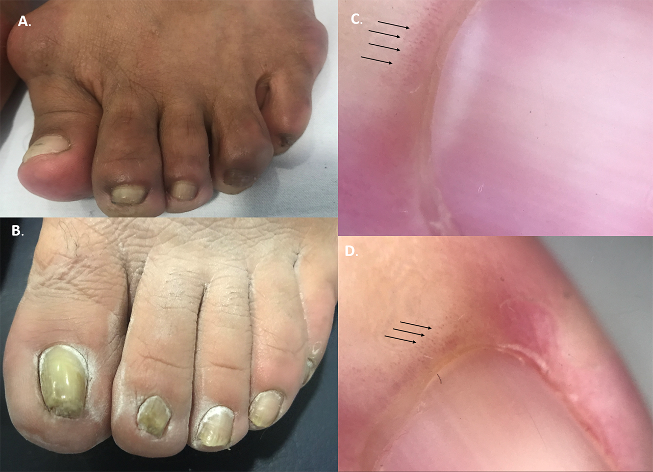 nail-abnormalities-in-a-cohort-of-rheumatoid-arthritis-patients