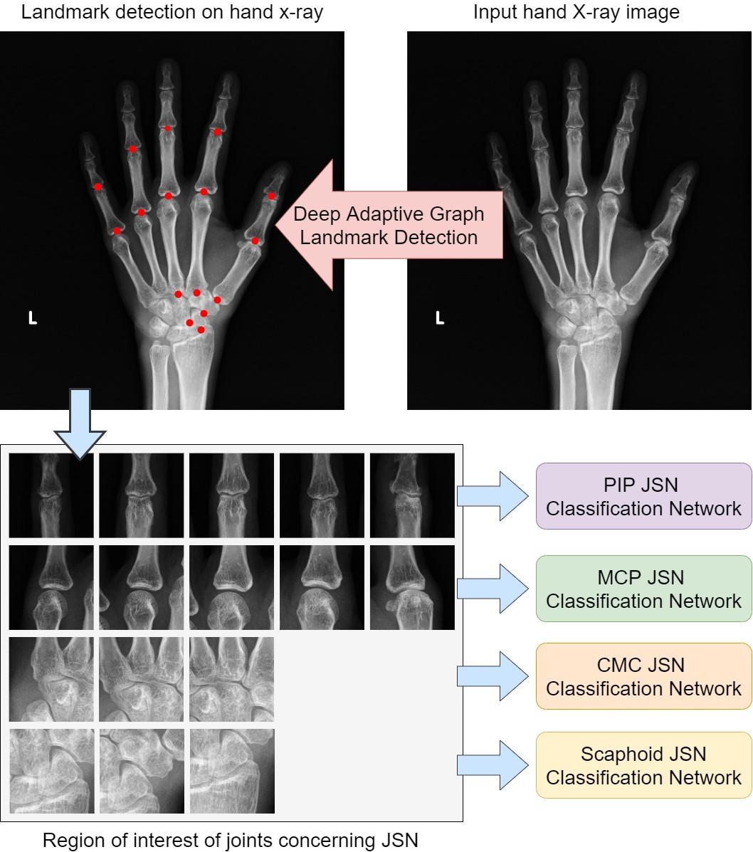 Rheumatoid Arthritis Hands X Ray