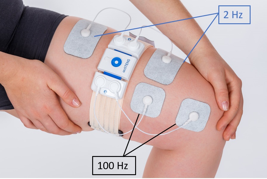 The Benefits of Electrical Stimulation after Knee Replacement - BSR Physical  Therapy