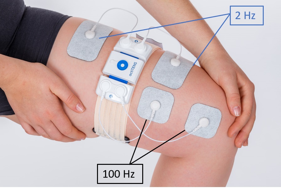 Transcutaneous Electrical Nerve Stimulation (TENS) for Rheumatoid Arthritis  (Practical Session) 