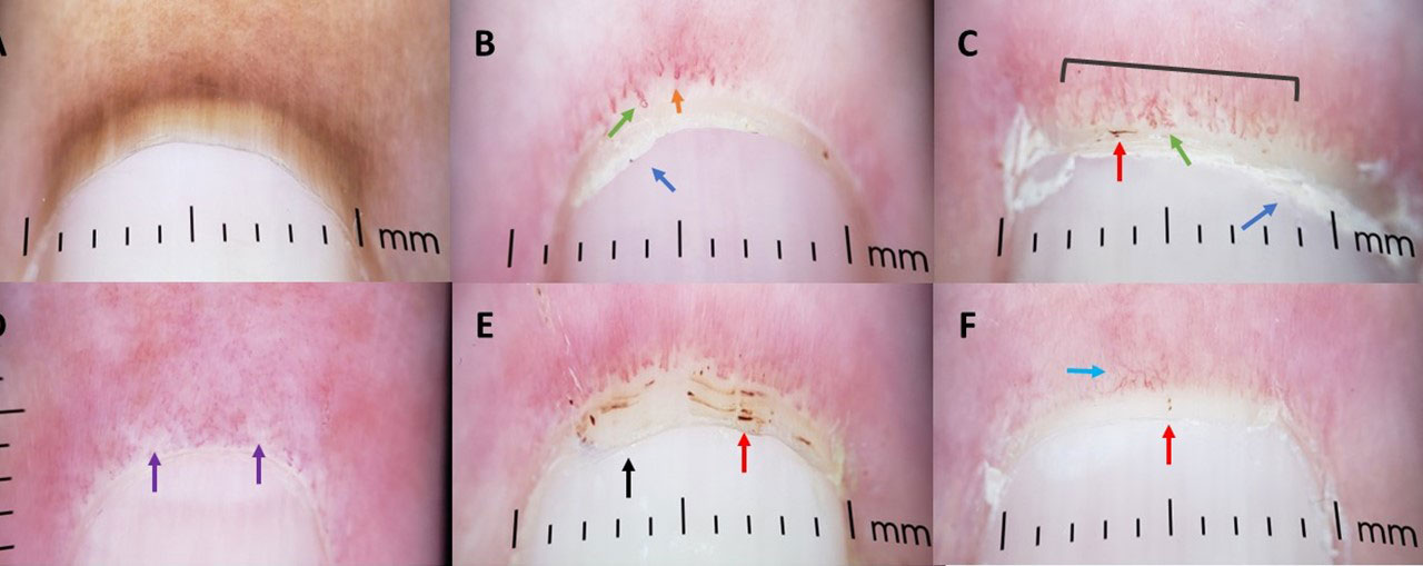 Clinical Applications of Nailfold Capillaroscopy in Different Rheumatic  Diseases